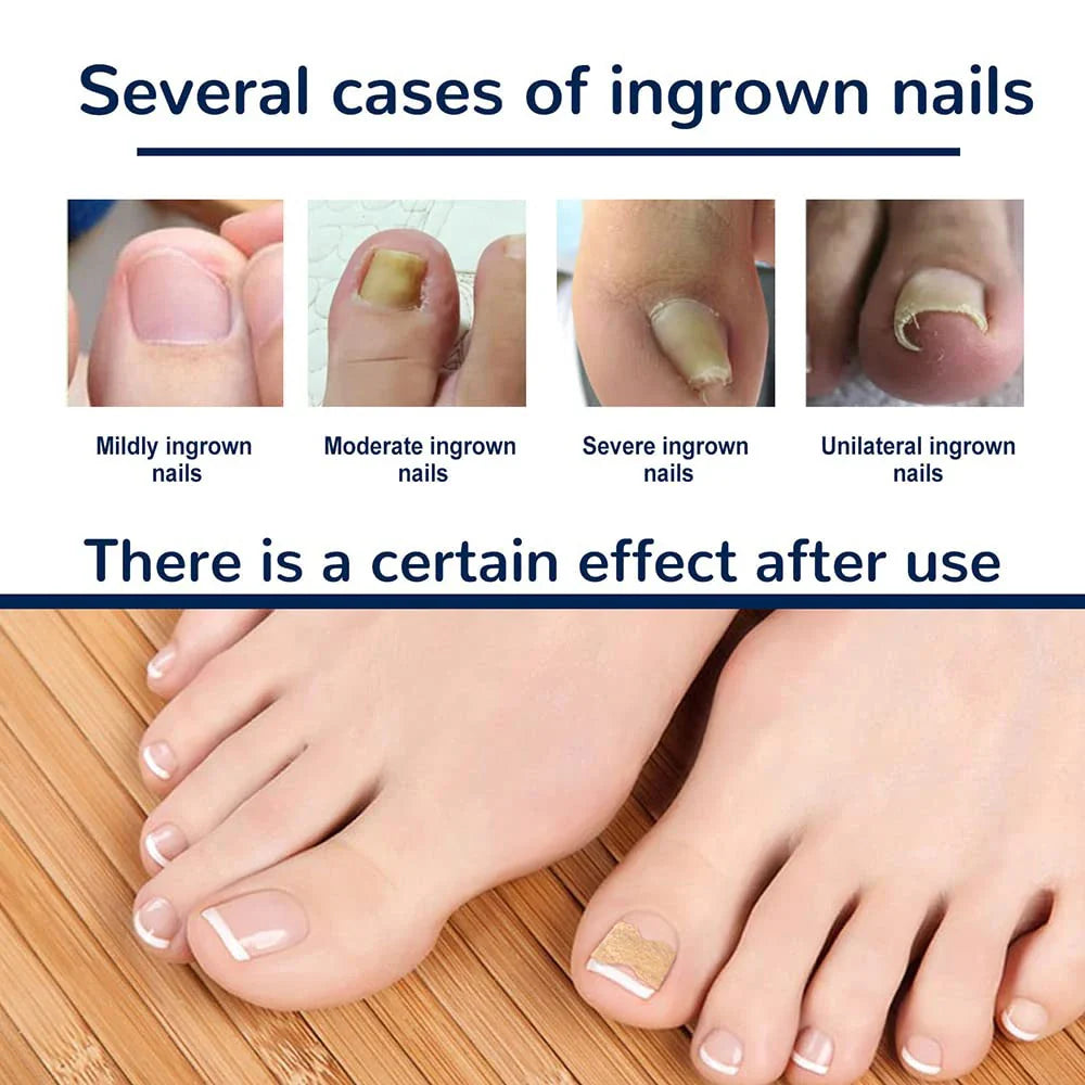 Ingrown Toenail Corrector Patches