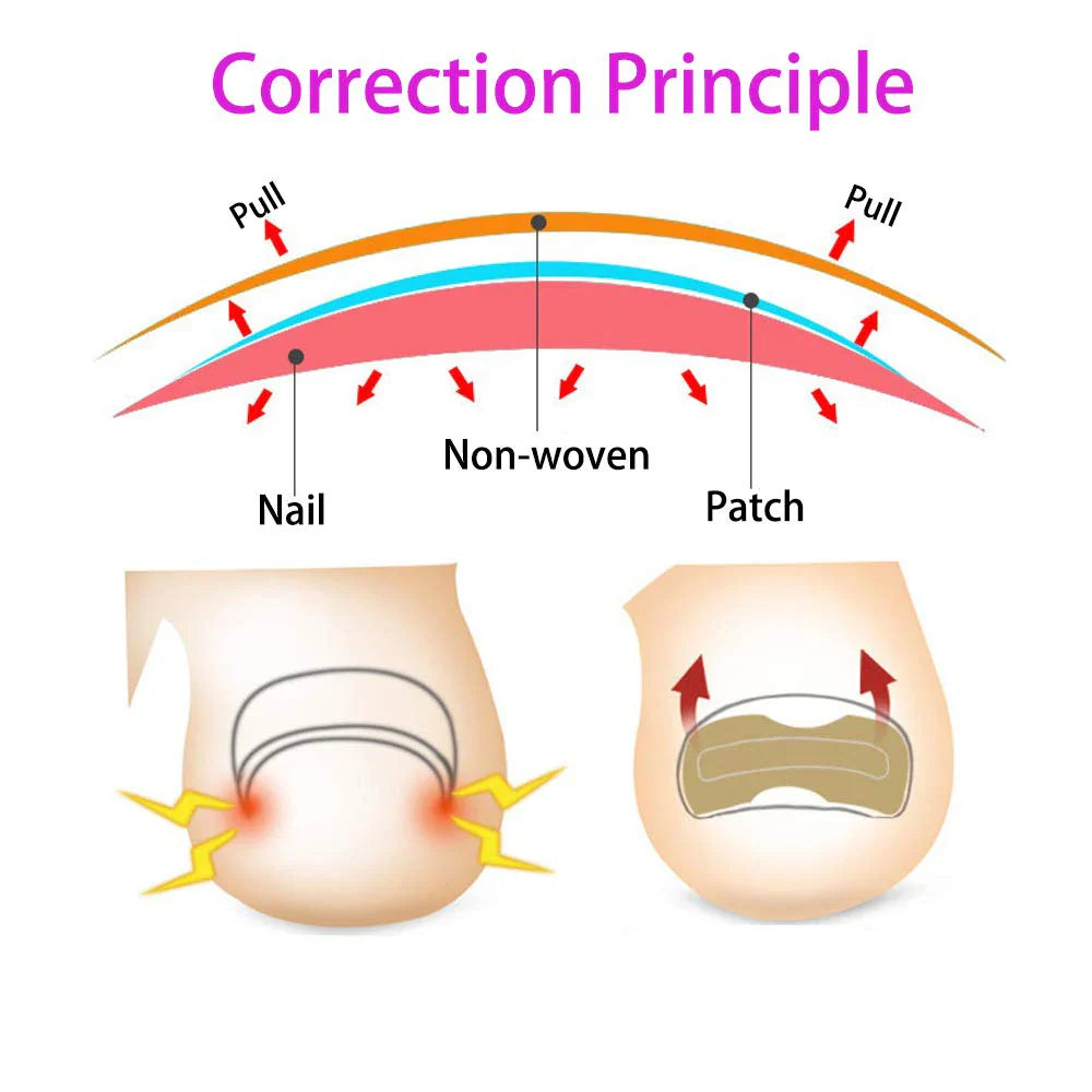 Ingrown Toenail Corrector Patches