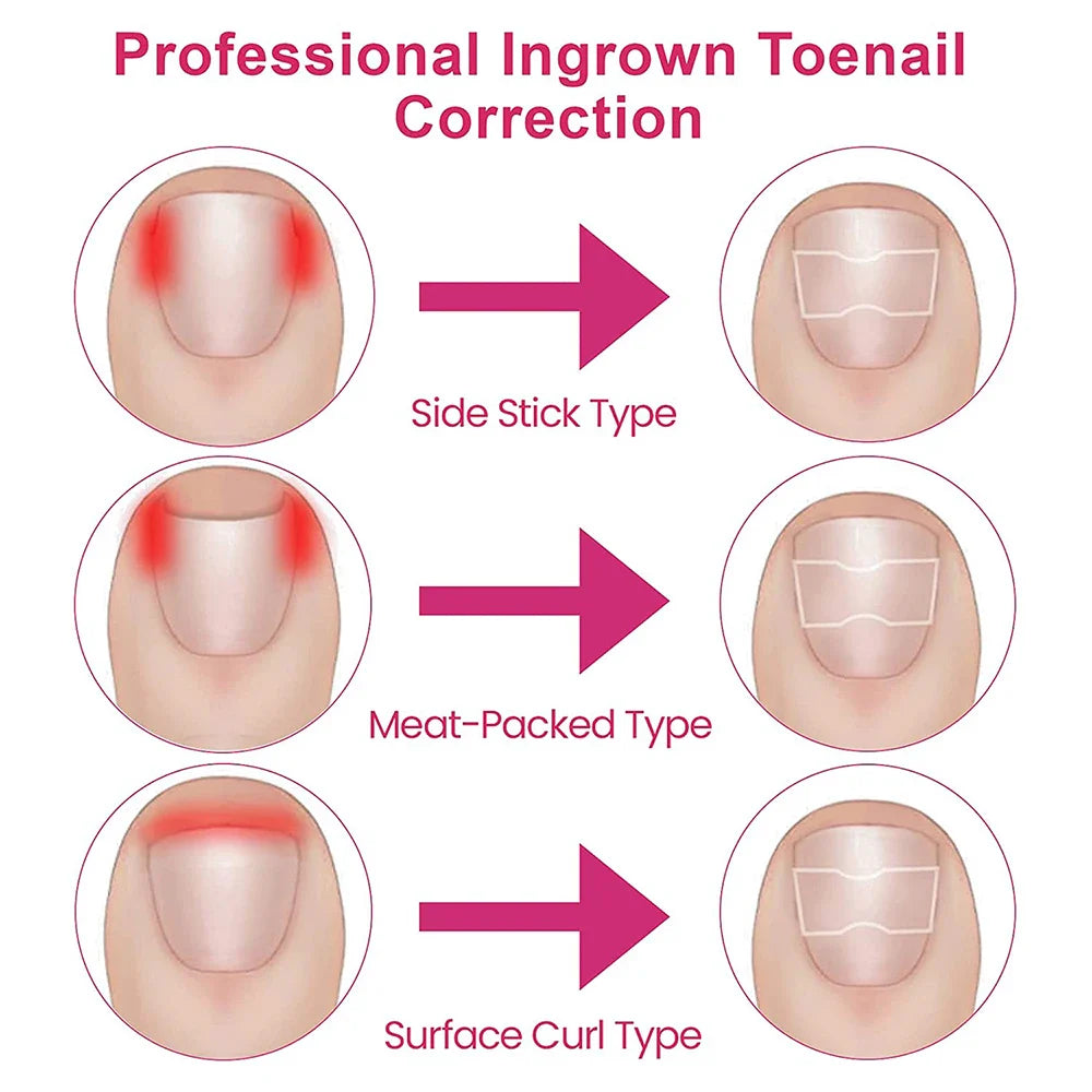 Ingrown Toenail Corrector Patches
