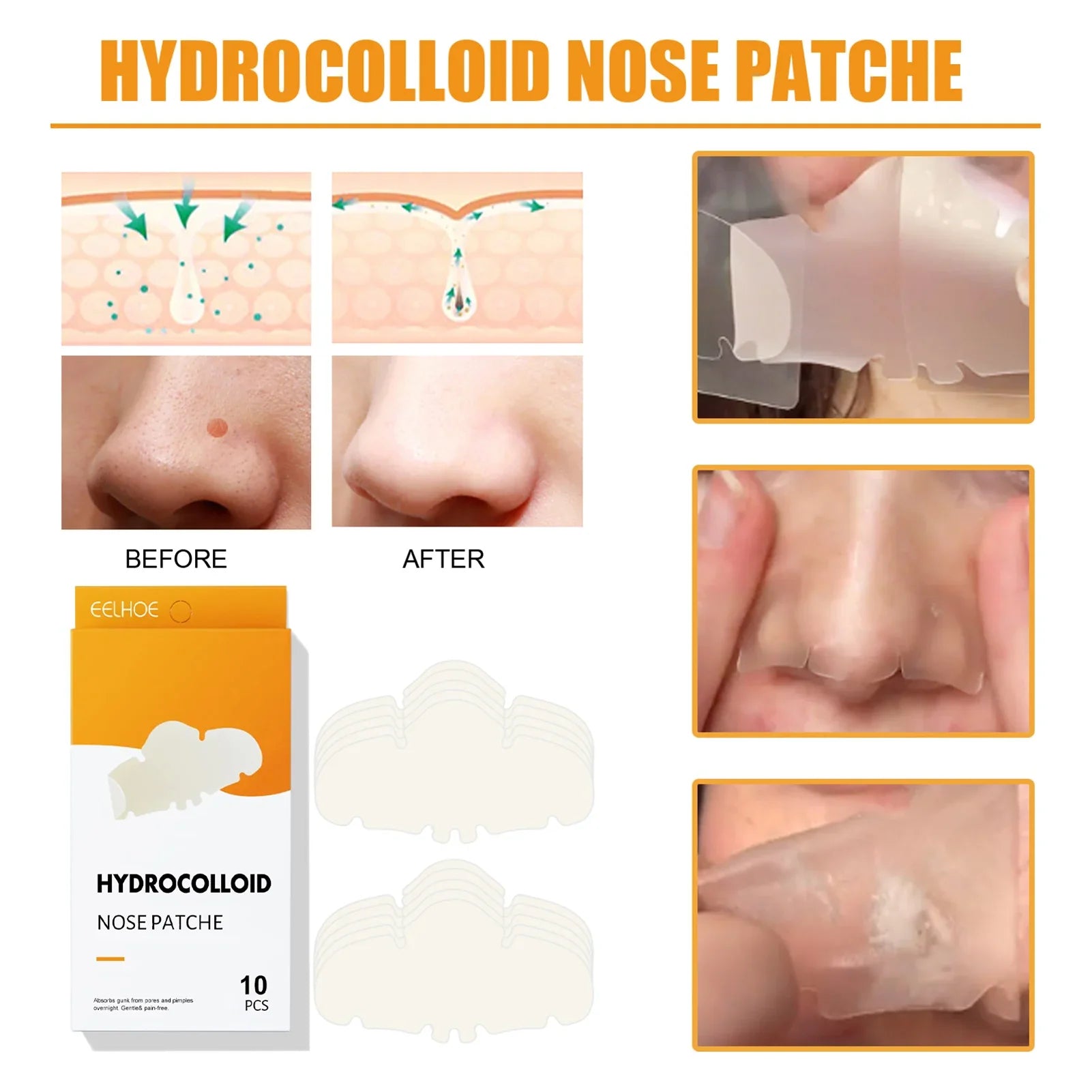 Blackhead & Acne Removal Strips