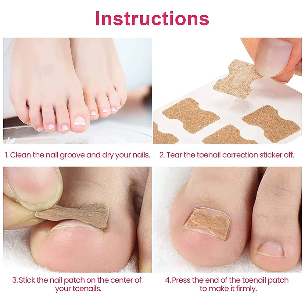 Ingrown Toenail Corrector Patches