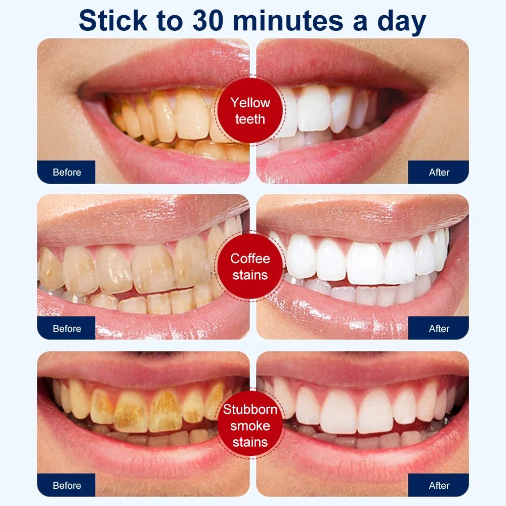 Teeth Whitening Strips